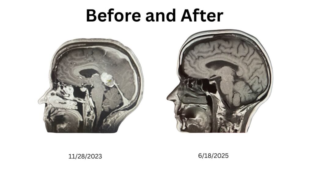 Navigating Medical Guidelines: A Cancer Rebel's Perspective 2 Beforeandafter