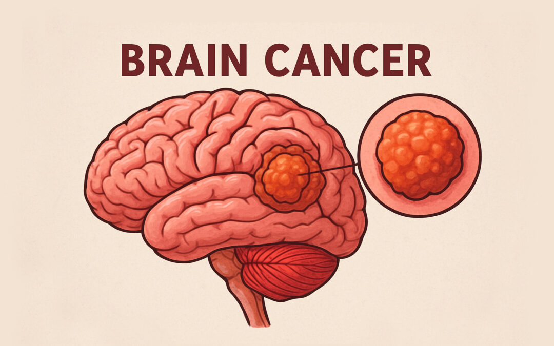 Brain Cancer